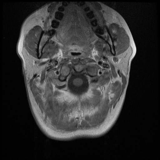 File:Normal cervical and thoracic spine MRI (Radiopaedia 35630-37156 Axial T1 C+ 30).png