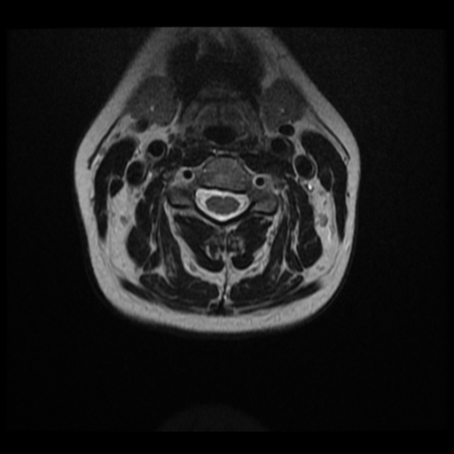 File:Normal cervical and thoracic spine MRI (Radiopaedia 35630-37156 Axial T2 21).png
