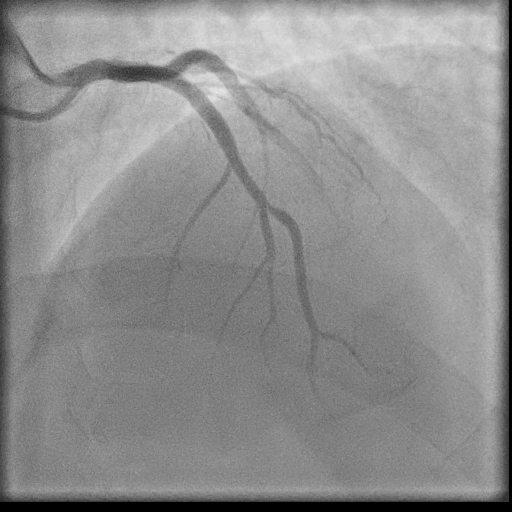 Normal coronary angiogram (DSA) (Radiopaedia 63081-71571 E 22).jpg