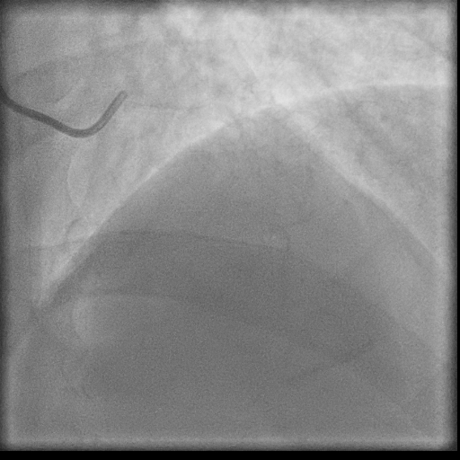 Normal coronary angiogram (DSA) (Radiopaedia 63081-71571 E 4).jpg