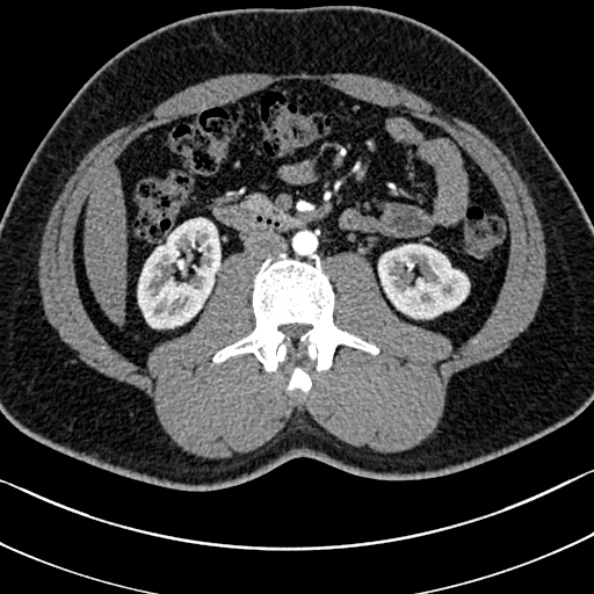 Normal kidneys on 4-phase CT study (Radiopaedia 25889-26038 B 57).jpg