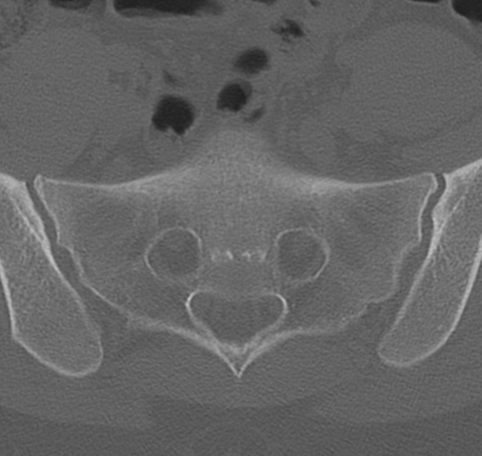File:Normal lumbar spine CT (Radiopaedia 46533-50986 Axial bone window 72).png