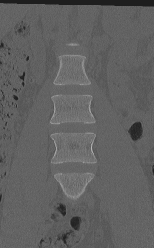 Normal lumbar spine CT (Radiopaedia 46533-50986 Coronal bone window 21).png