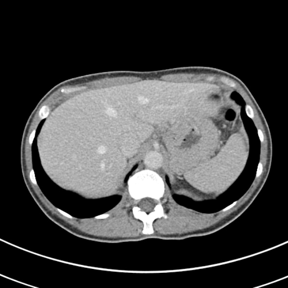 File:Normal multiphase CT liver (Radiopaedia 38026-39996 C 13).jpg