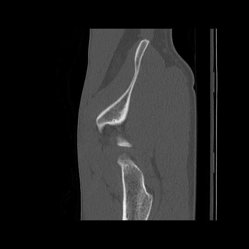Normal pelvis (Radiopaedia 51473-57238 Sagittal bone window 125).jpg