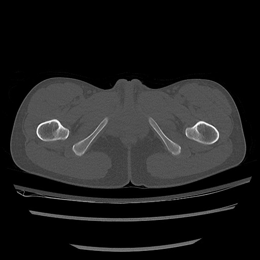 Normal pelvis CT (Radiopaedia 51471-57236 Axial bone window 99).jpg