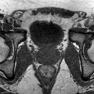 File:Normal prostate (MRI) (Radiopaedia 29986-30535 Axial T1 11).jpg