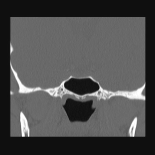 Normal sinus CT (annotated) (Radiopaedia 78917-91810 Coronal bone window 47).jpg