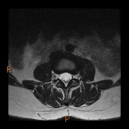 File:Normal spine MRI (Radiopaedia 77323-89408 Axial T2 7).jpg