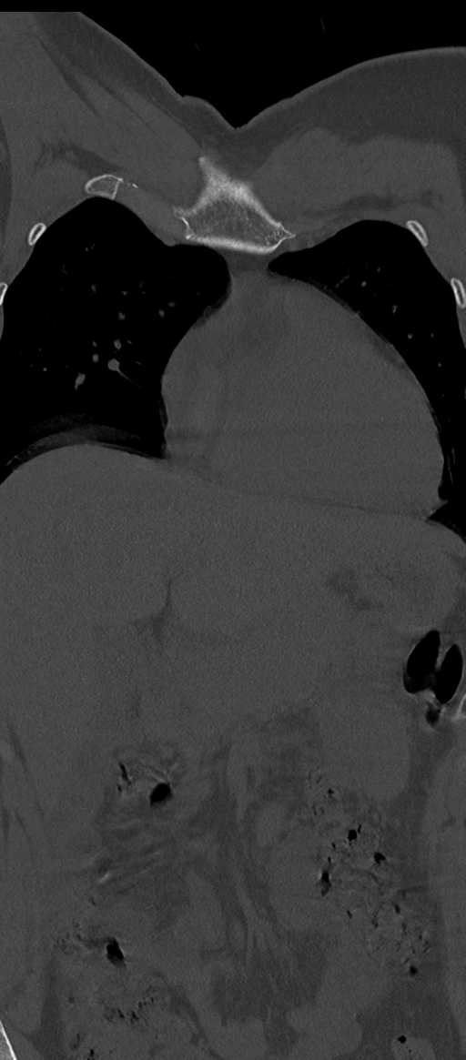 Normal thoracolumbar spine (Radiopaedia 43822-47309 Coronal bone window 4).png