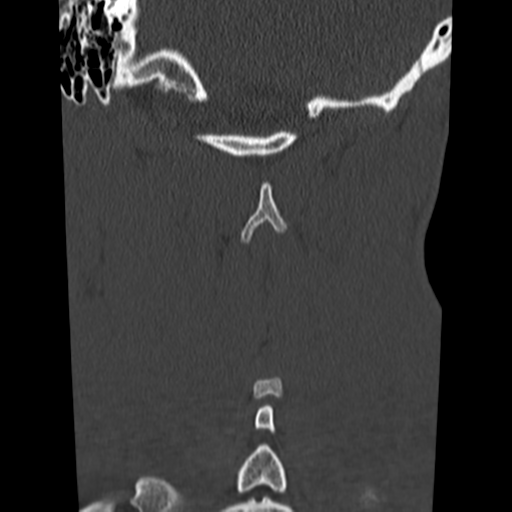 File:Normal trauma cervical spine (Radiopaedia 41017-43760 Coronal bone window 37).png