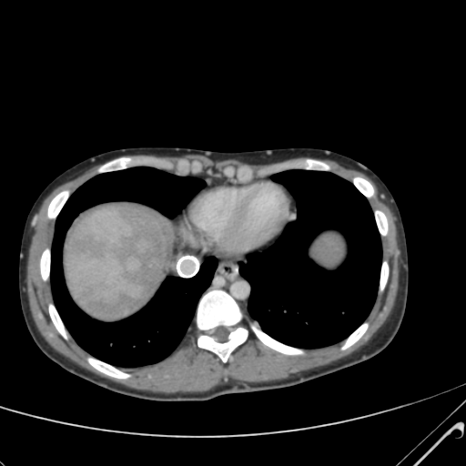 File:Nutmeg liver- Budd-Chiari syndrome (Radiopaedia 46234-50635 B 5).png