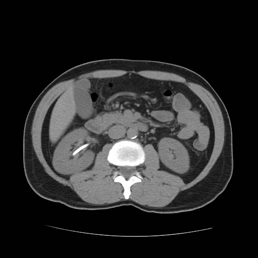 File:Obstructed kidney with perinephric urinoma (Radiopaedia 26889-27067 Axial non-contrast 13).jpg