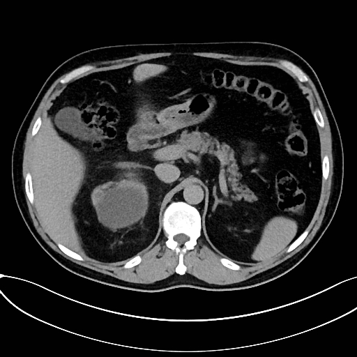 Obstructed upper pole ureter in a duplex kidney (Radiopaedia 54935-61221 Axial C+ delayed 1).jpg