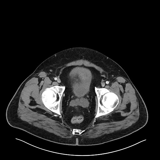 Obstructing sigmoid adenocarcinoma (Radiopaedia 58465-65619 A 151).jpg