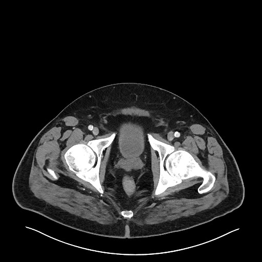 Obstructing sigmoid adenocarcinoma (Radiopaedia 58465-65619 A 156).jpg