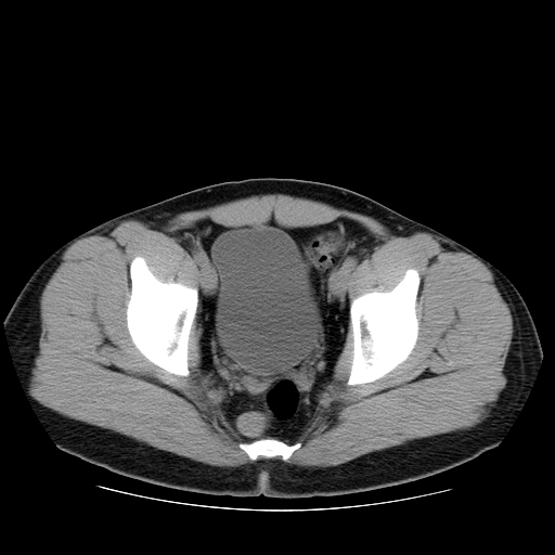 File:Obstructing ureteric calculus (Radiopaedia 18615-18514 Axial non-contrast 50).jpg