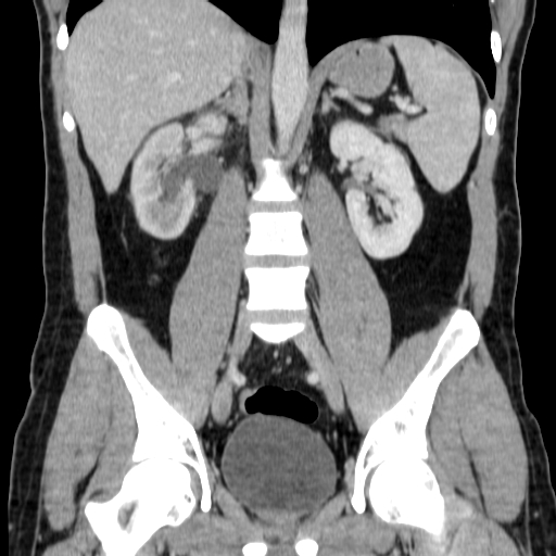 File:Obstructing ureteric calculus (Radiopaedia 18615-18514 C 45).jpg