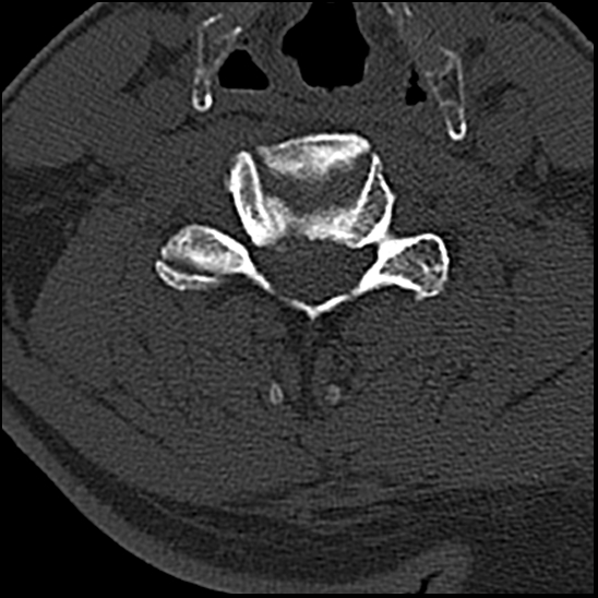 Occipital condyle fracture (type 1) (Radiopaedia 87670-104084 Axial bone window 54).jpg