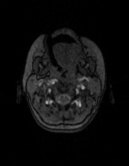 Occipital horn syndrome (Radiopaedia 14255-14129 MRA 4).jpg