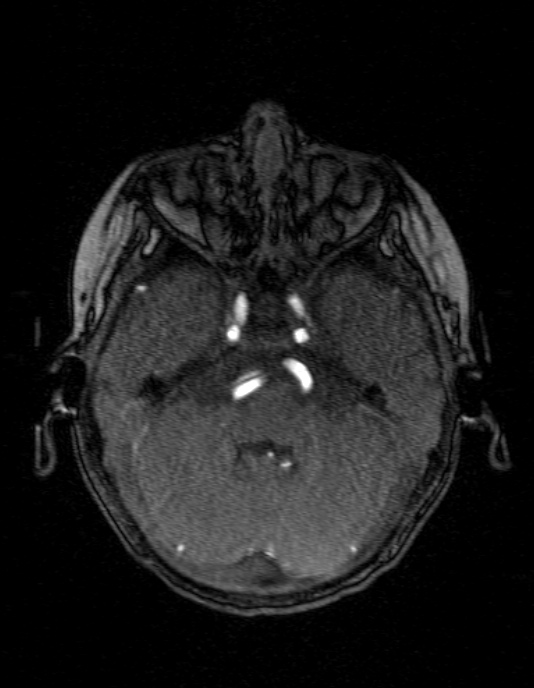 Occipital horn syndrome (Radiopaedia 14255-14129 MRA 41).jpg