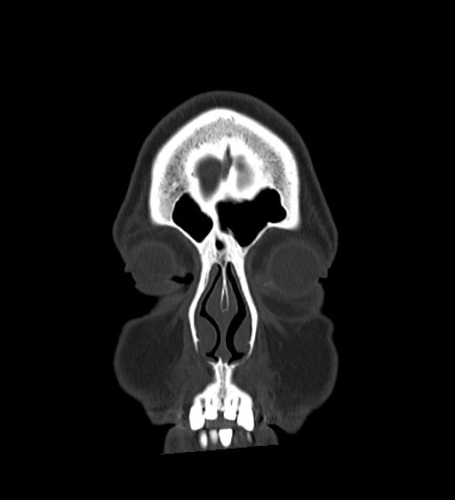 Occipital spur and Currarino type A atlas anomaly (Radiopaedia 87027-103285 Coronal bone window 29).jpg