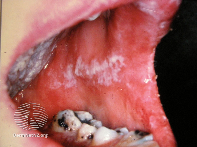 File:Oral candidiasis (DermNet NZ fungal-candor).jpg