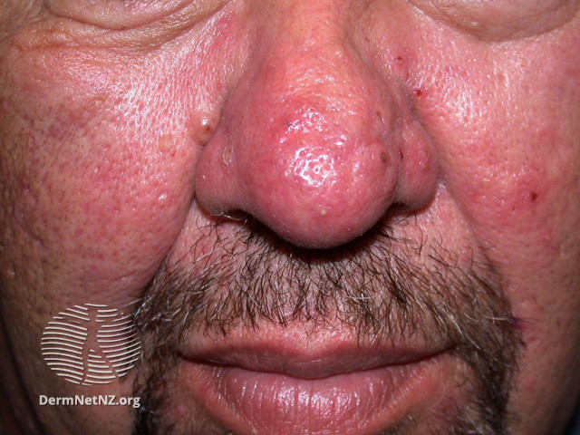 Rosacea (DermNet NZ acne-red-face-3648).jpg