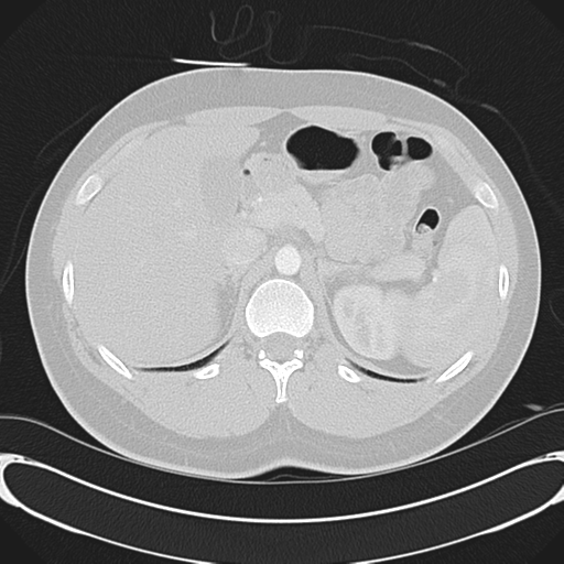 File:'Bovine' aortic arch (Radiopaedia 33554-34637 Axial lung window 67).png