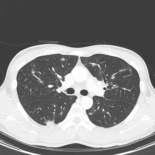AIDS-related Kaposi sarcoma (Radiopaedia 85247-100811 Axial lung window 64).jpg
