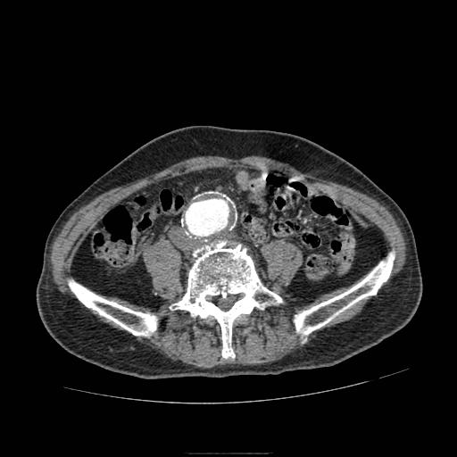 File:Abdominal aortic aneurysm (Radiopaedia 13341-13340 Axial C+ arterial phase 146).jpg