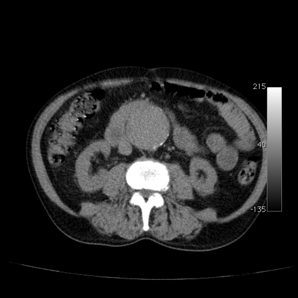Abdominal aortic aneurysm (Radiopaedia 29248-29660 Axial non-contrast 29).jpg