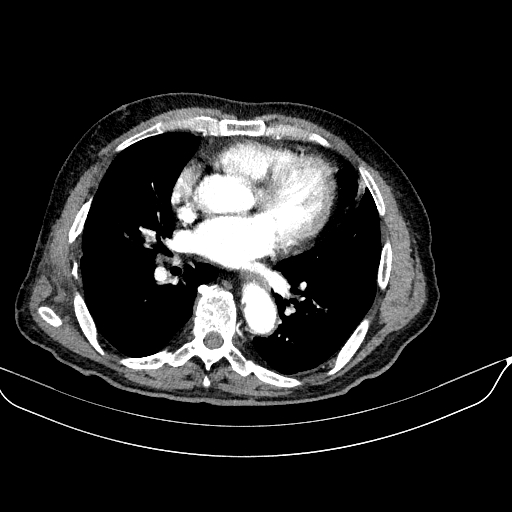 Abdominal aortic aneurysm (Radiopaedia 67117-76452 Axial C+ arterial phase 1).jpg