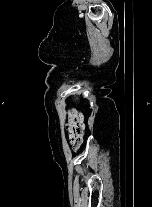 Abdominal aortic aneurysm (Radiopaedia 85063-100606 Sagittal C+ arterial phase 78).jpg