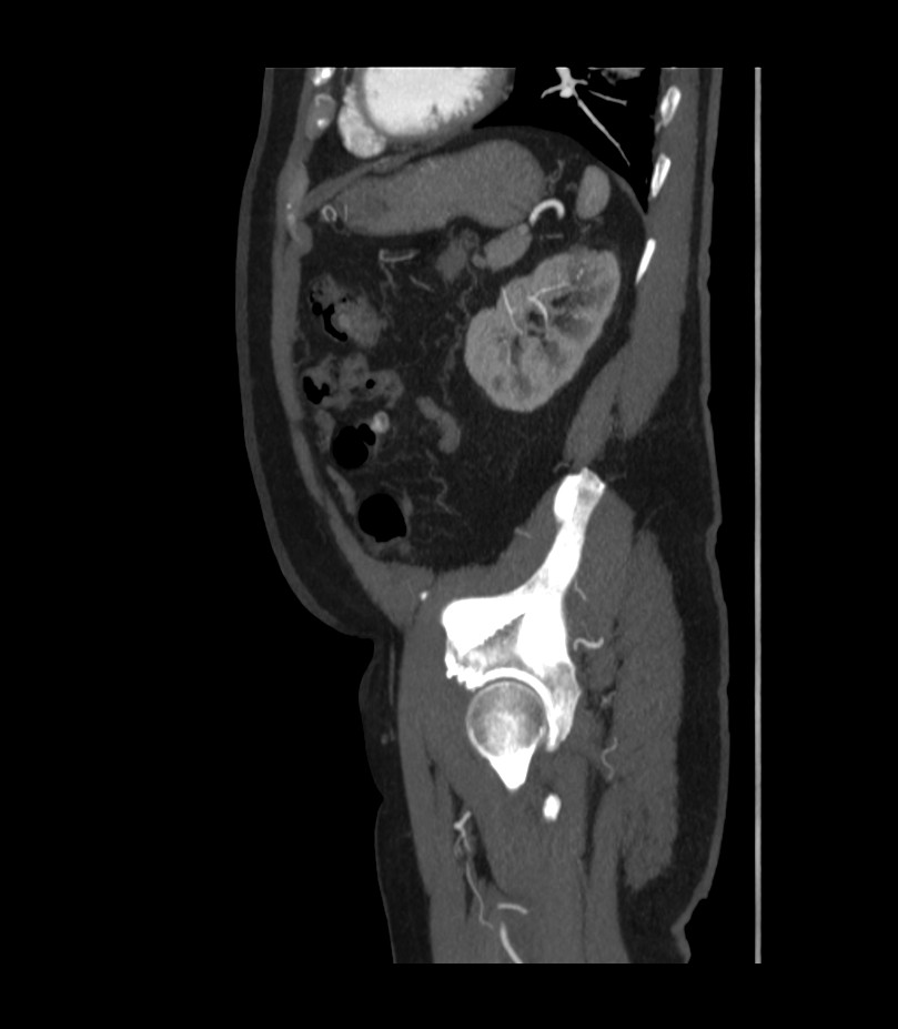 Abdominal aortic aneurysm with thrombus fissuration (Radiopaedia 46218-50618 Sagittal C+ arterial phase 46).jpg