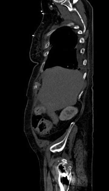 Abdominal aortic aneurysm with thrombus fissuration (Radiopaedia 73192-83919 Sagittal C+ arterial phase 121).jpg