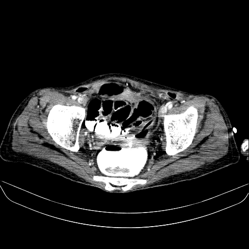 File:Abdominal collection due to previous cecal perforation (Radiopaedia 80831-94320 Axial C+ portal venous phase 183).jpg