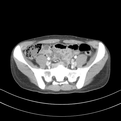 File:Abdominal multi-trauma - devascularised kidney and liver, spleen and pancreatic lacerations (Radiopaedia 34984-36486 Axial C+ portal venous phase 61).png