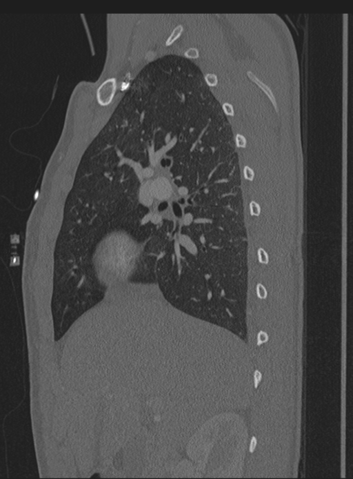 Abdominal multi-trauma - devascularised kidney and liver, spleen and pancreatic lacerations (Radiopaedia 34984-36486 Sagittal bone window 59).png