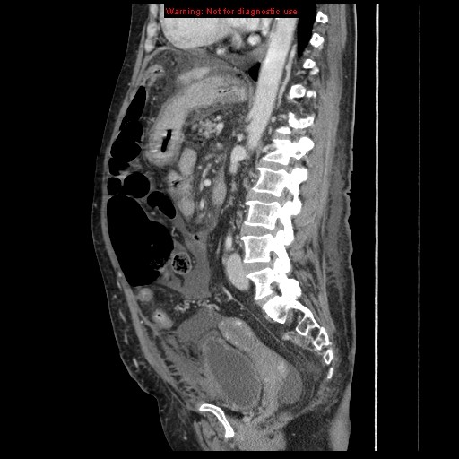 Abdominal wall hematoma (Radiopaedia 9427-10112 Sagittal C+ portal venous phase 46).jpg