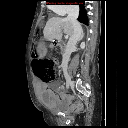 Abdominal wall hematoma (Radiopaedia 9427-10112 Sagittal C+ portal venous phase 64).jpg