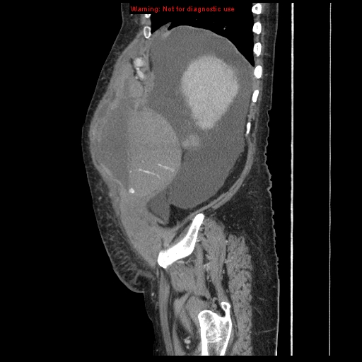 Abdominal wall hematoma (Radiopaedia 9427-10112 Sagittal C+ portal venous phase 89).jpg
