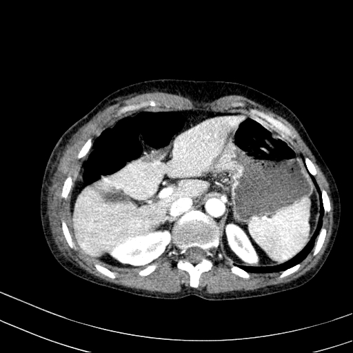 File:Abdominal wall hematoma with active bleeding (Radiopaedia 83915-99117 Axial renal cortical phase 2).jpg