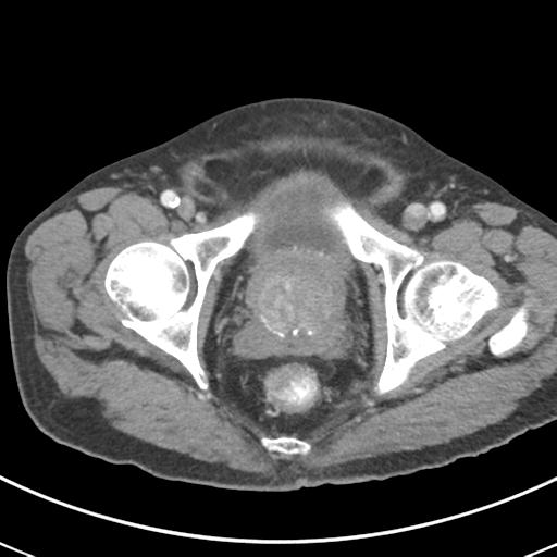 Abdominal wall metastasis from colorectal carcinoma (Radiopaedia 31016-31717 Axial C+ portal venous phase 73).jpg