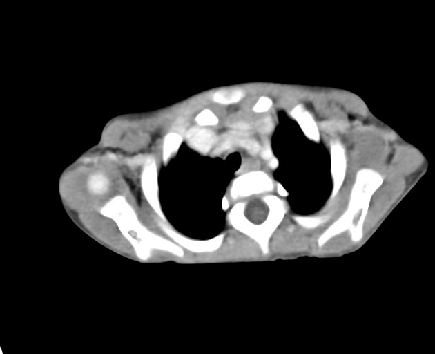 File:Abdominopelvic rhabdomyosarcoma (Radiopaedia 78356-90984 Axial C+ portal venous phase 5).jpg