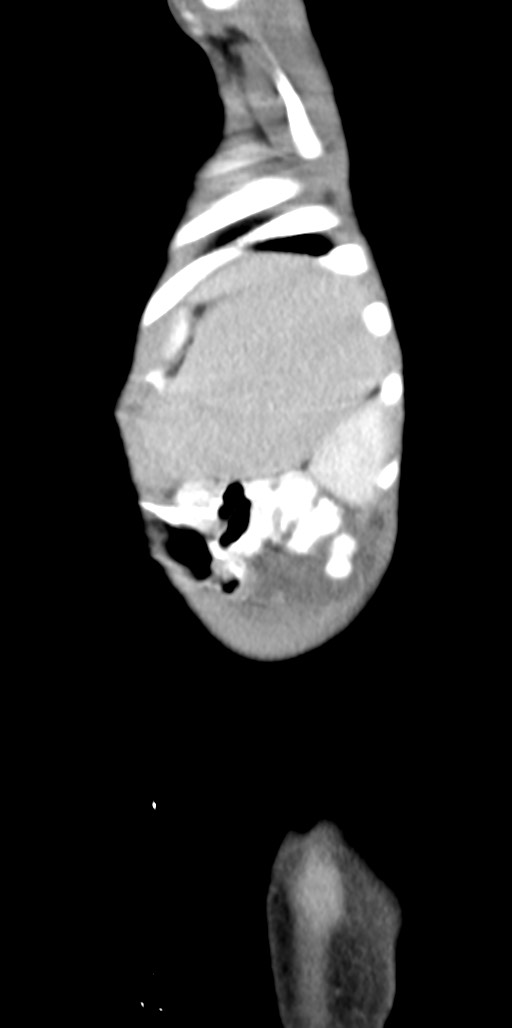 Abdominopelvic rhabdomyosarcoma (Radiopaedia 78356-90984 Sagittal C+ portal venous phase 12).jpg