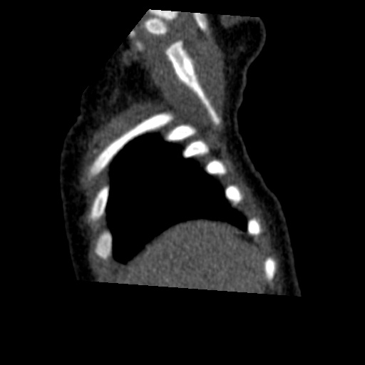 Aberrant left pulmonary artery (pulmonary sling) (Radiopaedia 42323-45435 Sagittal C+ arterial phase 5).jpg