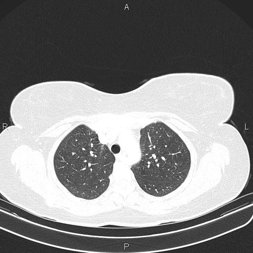 Aberrant right subclavian artery (Radiopaedia 87334-103629 Axial lung window 21).jpg