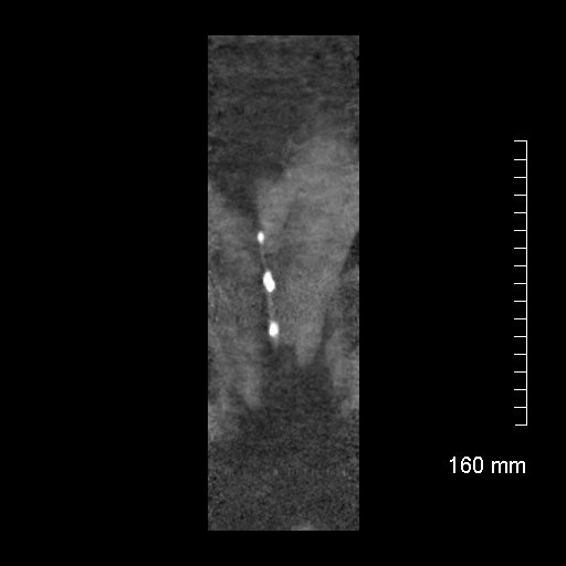 Aberrant right subclavian artery stenosis (Radiopaedia 52656-58670 B 82).jpg