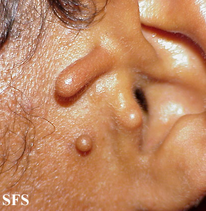 Accessory Tragus (Dermatology Atlas 2).jpg